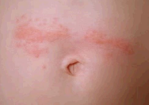 Rash Around Belly Button: Causes and Treatments | New Health Advisor