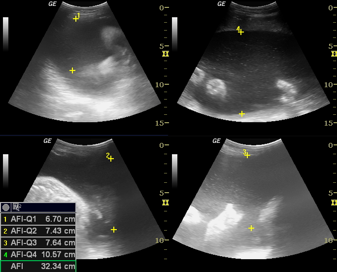 Ila Normal Amniotic Fluid Index Chart | New Health Advisor