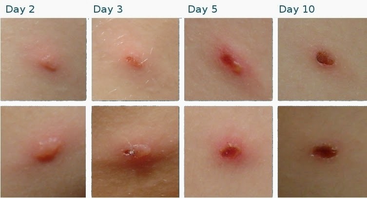 Chickenpox Pattern What does Chickenpox Look Like? | New Health Advisor