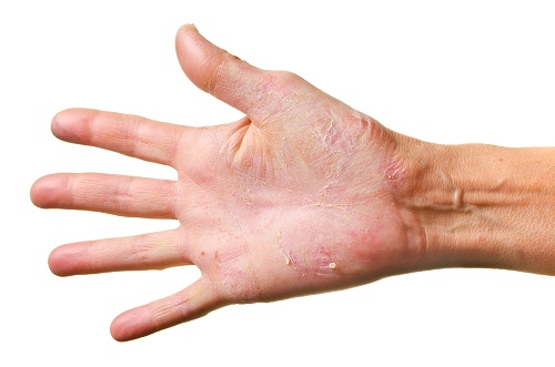 Athlete's Foot on Hands: Causes and Remedies | New Health Advisor