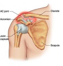 Dislocated Collar Bone: Causes, Signs & Treatments | New Health Advisor