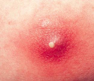Hard Abscess On Buttocks _ Boils (Skin Abscesses) Pictures, Treatment ...